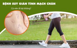 bẹnh suy giãn tĩnh mạch có nên đi bộ không