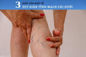 Giãn tĩnh mạch chi dưới