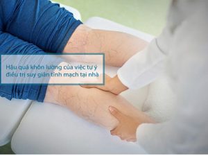 hậu quả điều trị suy giãn tĩnh mạch tại nhà