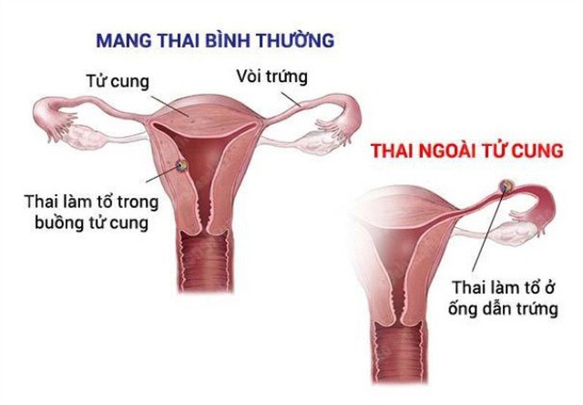 Biến chứng thai kỳ cần lưu ý - Ảnh 1.